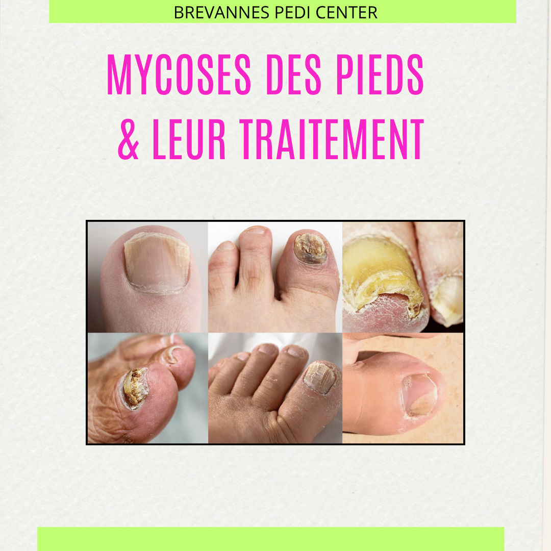 <b>LES MYCOSES DES PIEDS</b> :<br>14/11/2026 · 11h00 - 17h30 </br>
